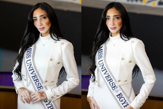 Una mujer con vitíligo participará en el Miss Universo 2024